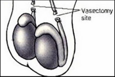 вазэктомия - хирургическая контрацепция для мужчин